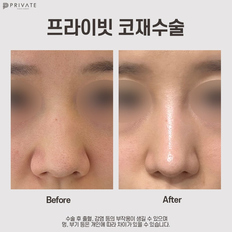 Klinik Bedah Plastik Revisi Hidung adalah Klinik Bedah Plastik Privat 사진 7