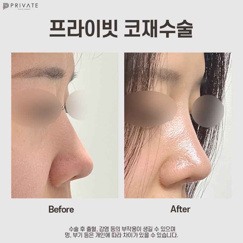 Klinik Bedah Plastik Revisi Hidung adalah Klinik Bedah Plastik Privat 사진 9