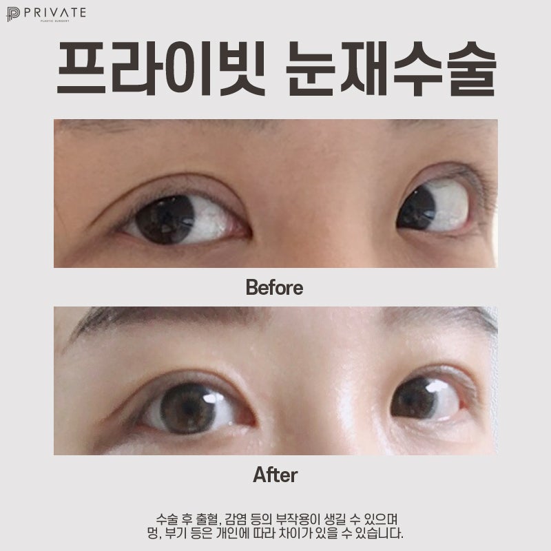 소세지눈 재수술 후기가 좋은 프라이빗성형외과 사진 9