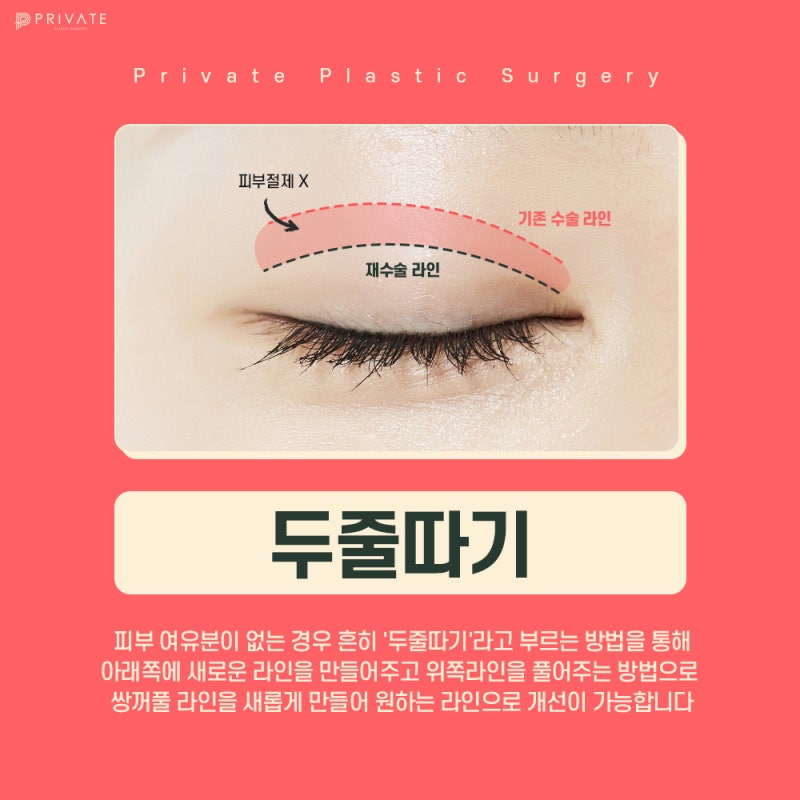 눈재수술유명한곳 신사 프라이빗성형외과 사진 5