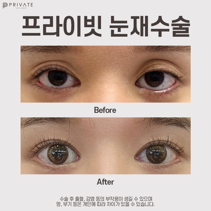 눈재수술유명한곳 신사 프라이빗성형외과 사진 9