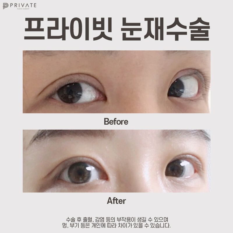 눈재수술유명한곳 신사 프라이빗성형외과 사진 8