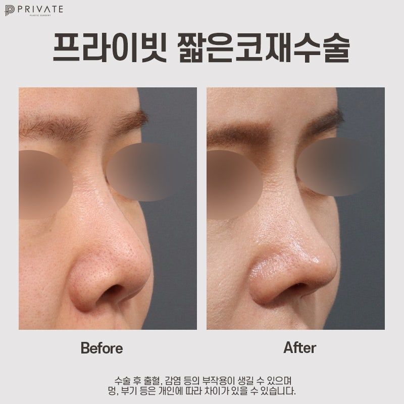 Tempat Terbaik untuk Operasi Revisi Hidung Pendek adalah Private Plastic Surgery 사진 9