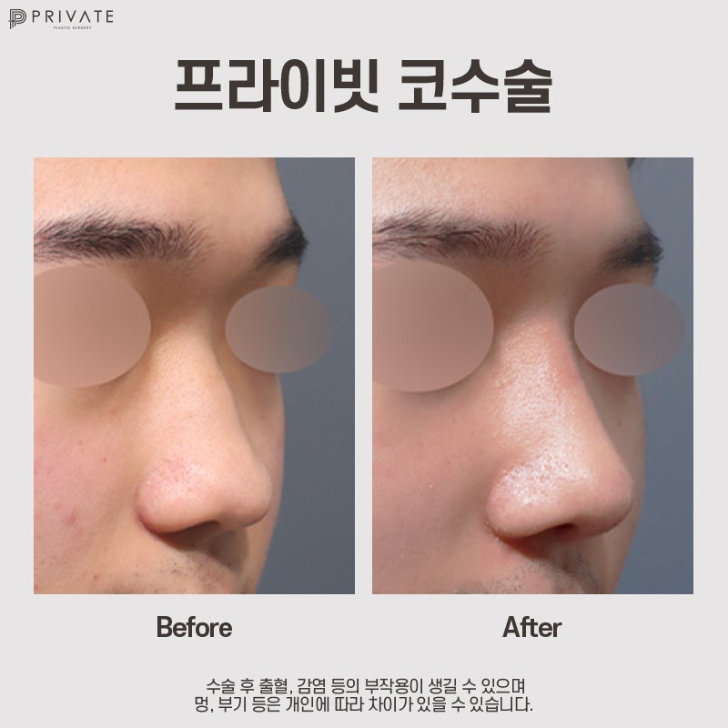Ulasan Bagus tentang Operasi Hidung Pria Sebelum dan Sesudah di Private Plastic Surgery 사진 11