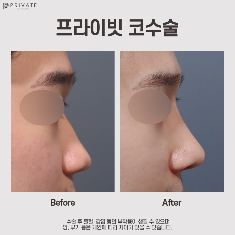 Ulasan Bagus tentang Operasi Hidung Pria Sebelum dan Sesudah di Private Plastic Surgery 사진 10