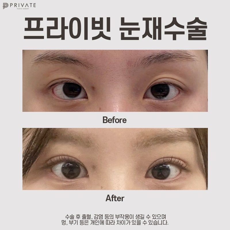 Bệnh viện phẫu thuật mắt cắt mí chỉnh sửa tốt tại Sinsa – Private Plastic Surgery 사진 8