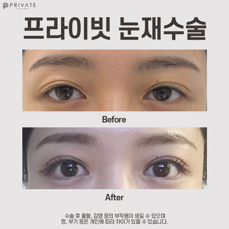 눈재수술성형외과는 신사 프라이빗성형외과 사진 8