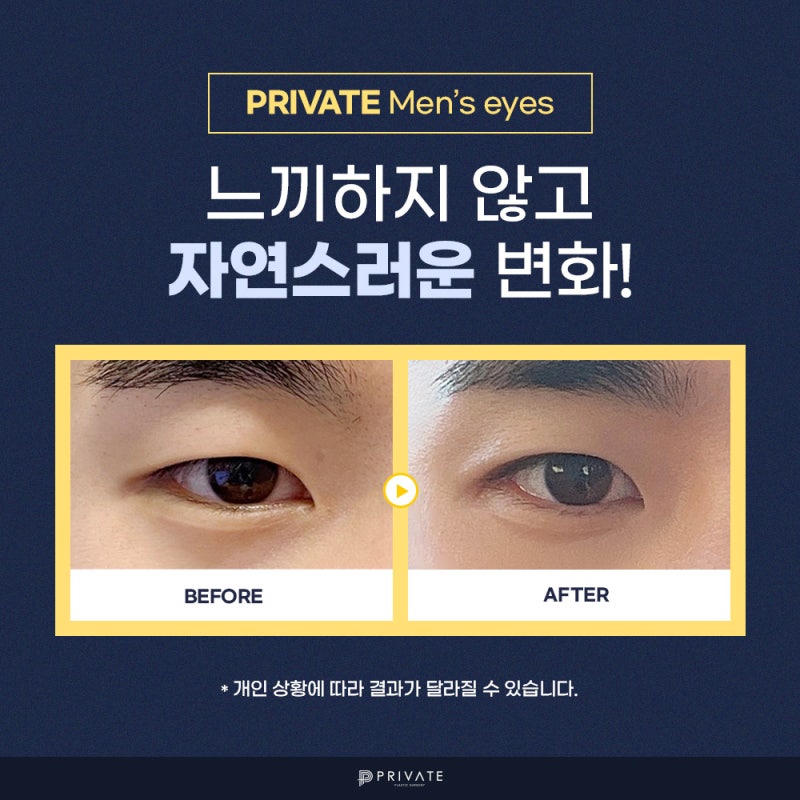 擅长男性眼部手术的医院是新沙Private整形外科 사진 5