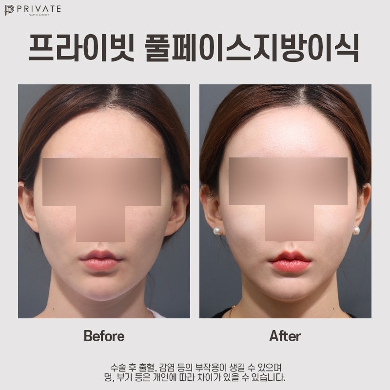 프라이빗성형외과 PRP풀페이스지방이식 사진 10
