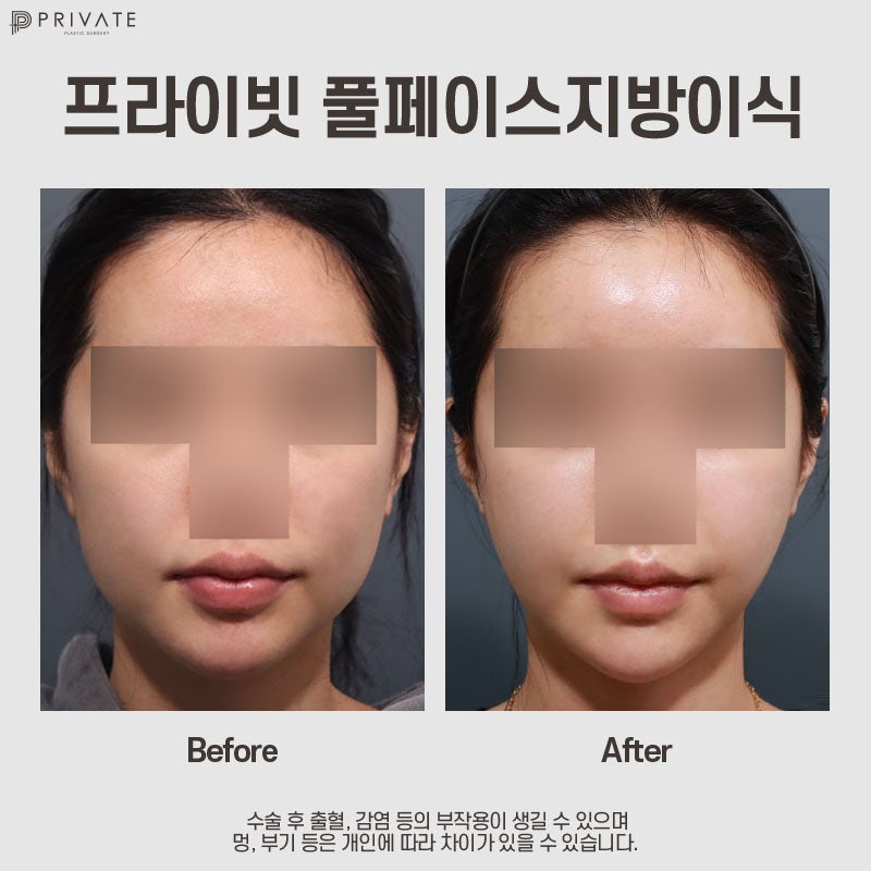 프라이빗성형외과 PRP풀페이스지방이식 사진 8