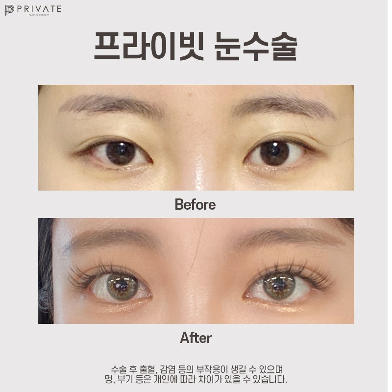 첫눈성형수술은 신사역 프라이빗성형외과 사진 9