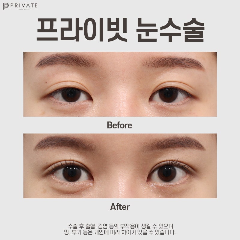 첫눈성형수술은 신사역 프라이빗성형외과 사진 8