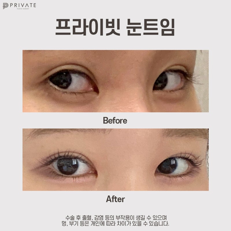 뒷밑트임 후기 좋은 신사역 프라이빗성형외과 사진 10