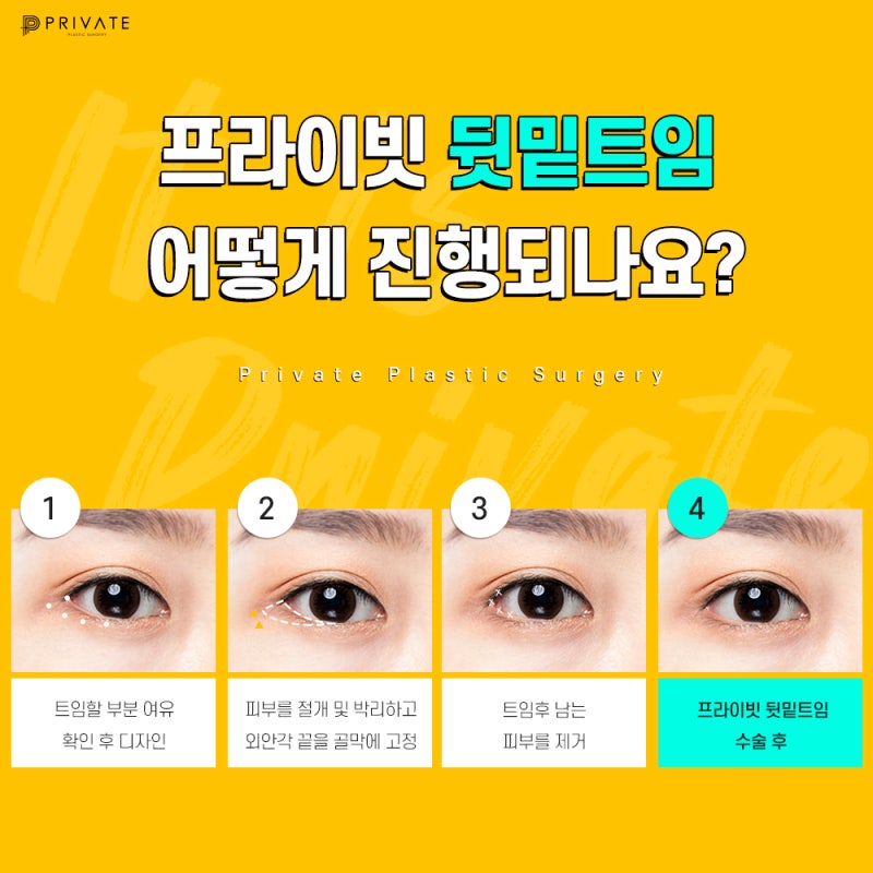 뒷밑트임 후기 좋은 신사역 프라이빗성형외과