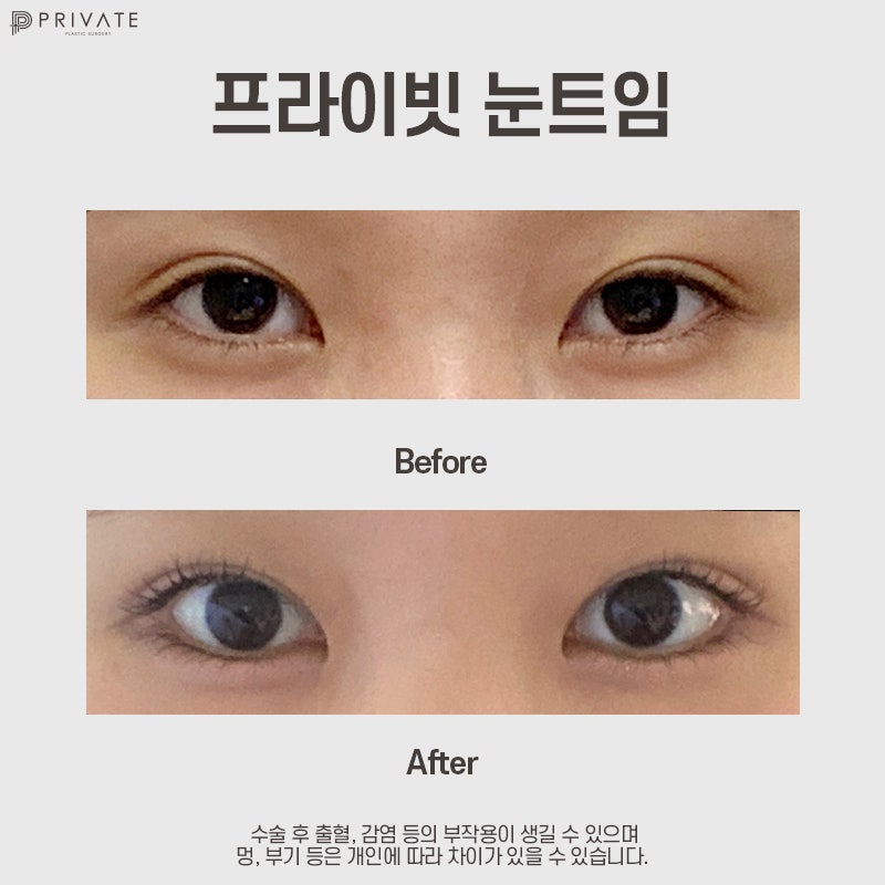 뒷밑트임 후기 좋은 신사역 프라이빗성형외과 사진 11