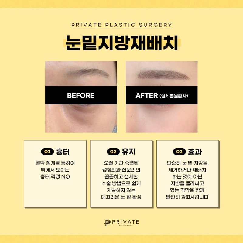 Ulasan Bagus untuk Operasi Kantung Mata di Sinsa Private Plastic Surgery 사진 5