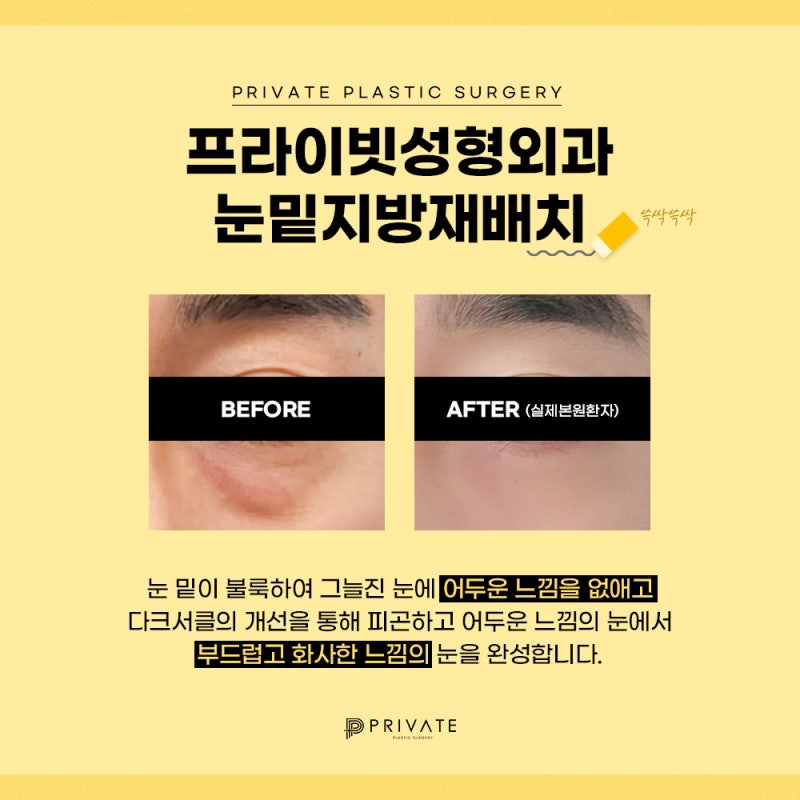 Ulasan Bagus untuk Operasi Kantung Mata di Sinsa Private Plastic Surgery