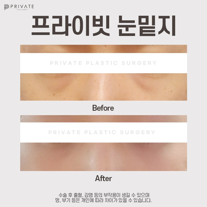 Ulasan Bagus untuk Operasi Kantung Mata di Sinsa Private Plastic Surgery 사진 8