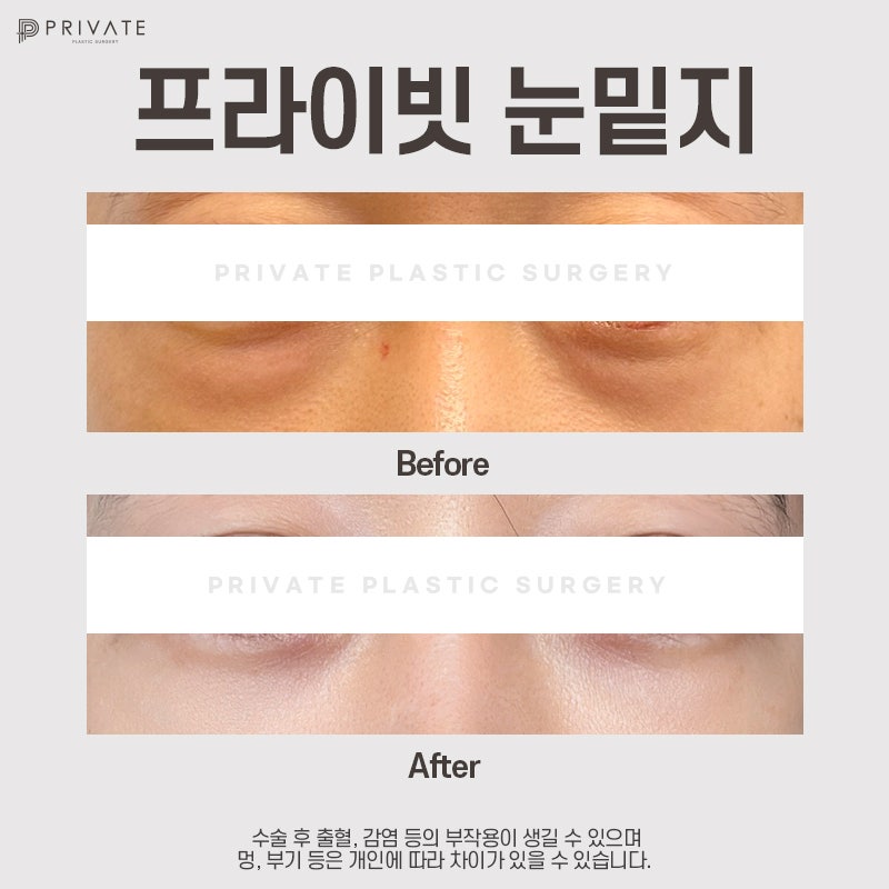 Ulasan Bagus untuk Operasi Kantung Mata di Sinsa Private Plastic Surgery 사진 7