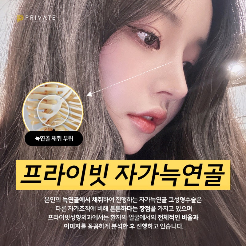 Ulasan Operasi Hidung Tulang Rawan Rusuk Autologus di Private Plastic Surgery yang Bagus