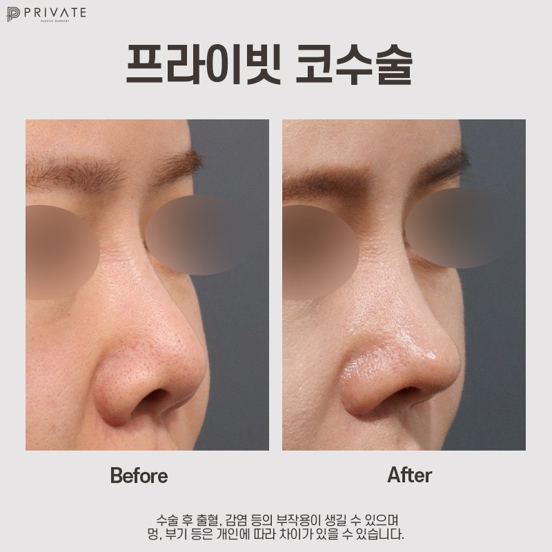 Ulasan Operasi Hidung Tulang Rawan Rusuk Autologus di Private Plastic Surgery yang Bagus 사진 9