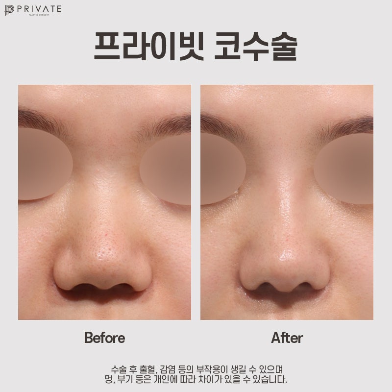 Ulasan Operasi Hidung Tulang Rawan Rusuk Autologus di Private Plastic Surgery yang Bagus 사진 7