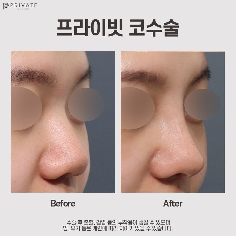 Ulasan Operasi Hidung Tulang Rawan Rusuk Autologus di Private Plastic Surgery yang Bagus 사진 8