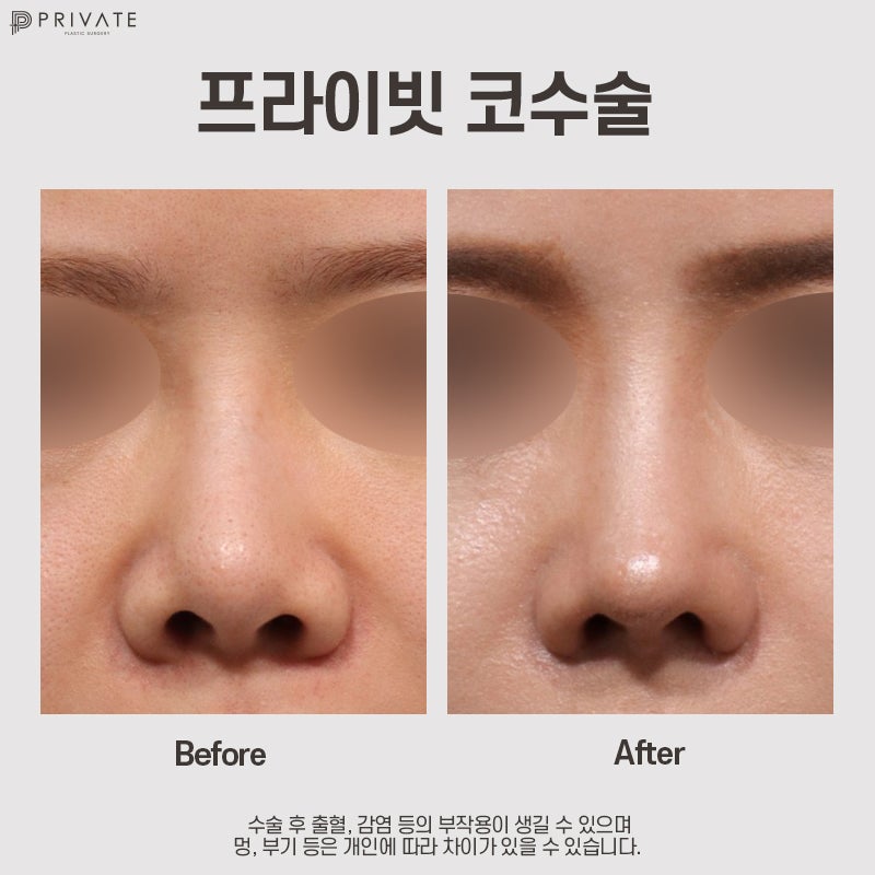 Ulasan Operasi Hidung Tulang Rawan Rusuk Autologus di Private Plastic Surgery yang Bagus 사진 10