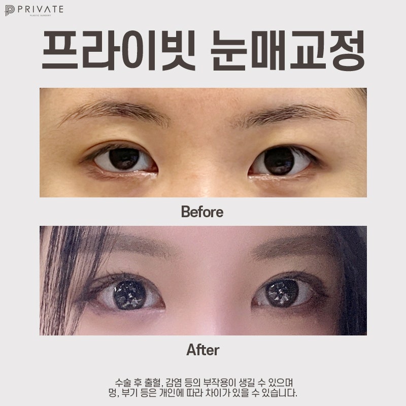 눈매교정술 프라이빗성형외과에서 알아보기 사진 8