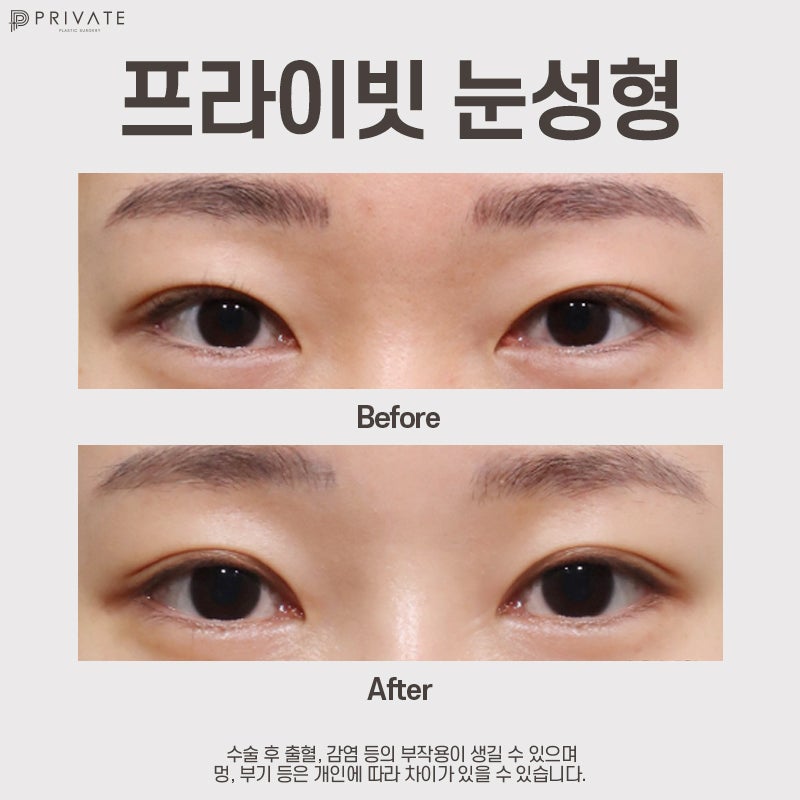 Tempat Terbaik untuk Operasi Kelopak Mata Ganda: Private Plastic Surgery Clinic Sinsa 사진 9