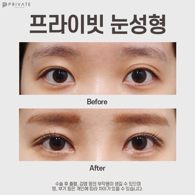 Tempat Terbaik untuk Operasi Kelopak Mata Ganda: Private Plastic Surgery Clinic Sinsa 사진 8