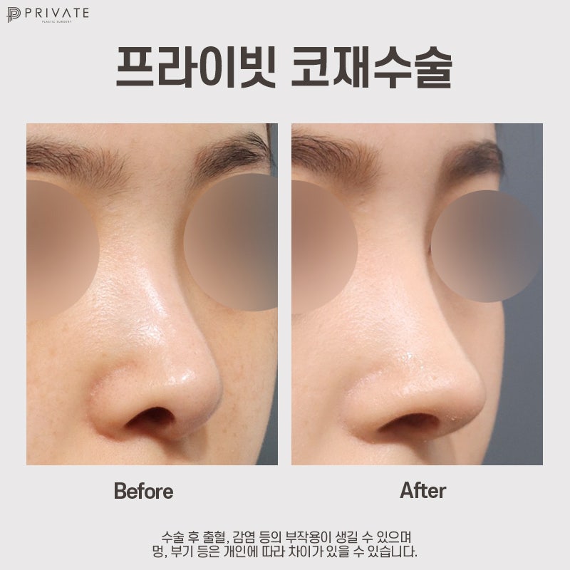 코재수술후기가 궁금하다면 신사 프라이빗성형외과 사진 9