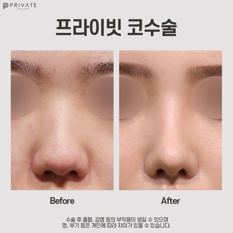 Operasi Hidung Babi di Sinsa Private Plastic Surgery, Lihat Sebelum dan Sesudah 사진 7