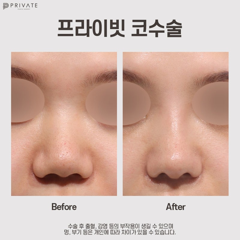 Operasi Hidung Babi di Sinsa Private Plastic Surgery, Lihat Sebelum dan Sesudah 사진 8