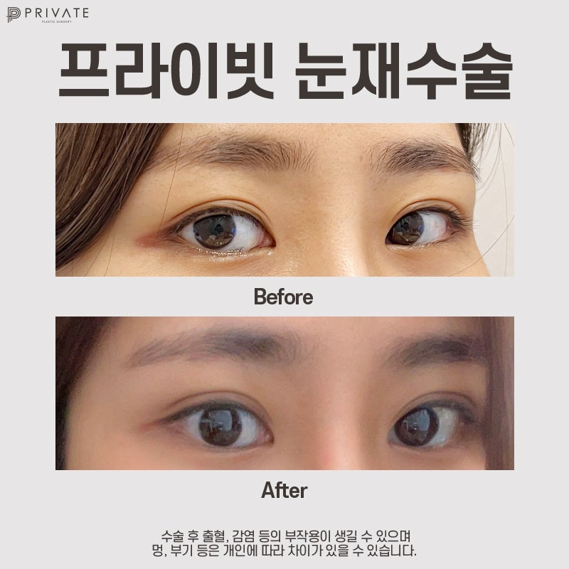눈재수술잘하는곳은 신사 프라이빗성형외과 사진 9