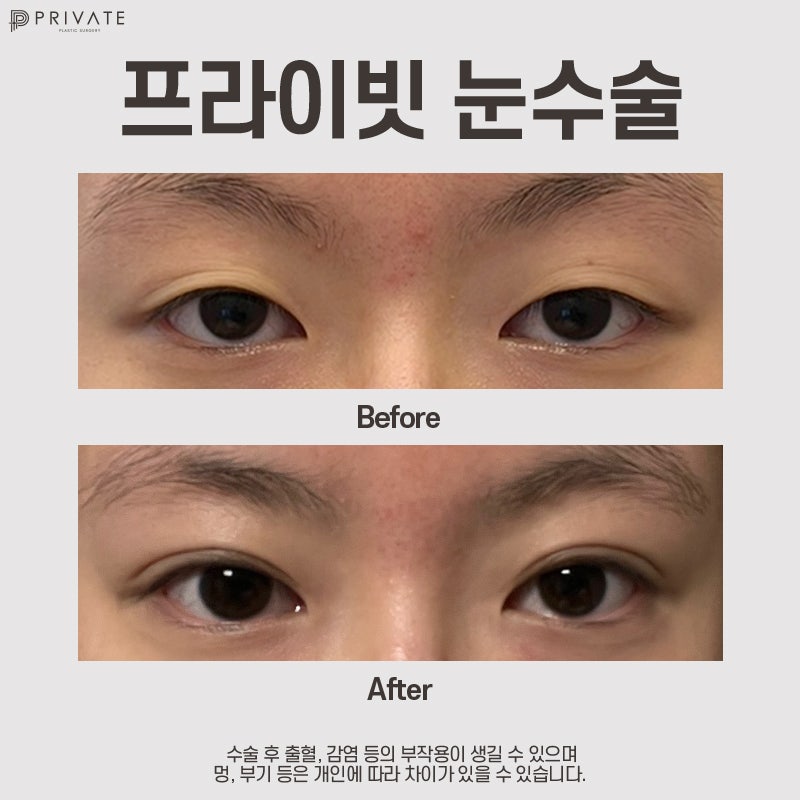 Ulasan Bagus Operasi Revisi Penyatuan Alami di Private Plastic Surgery 사진 10
