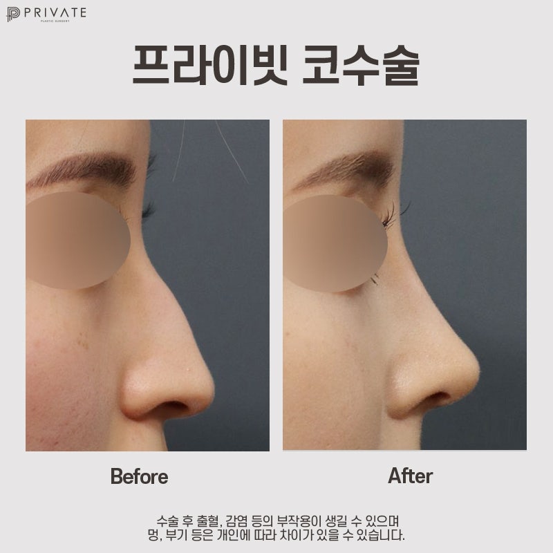 매부리코성형병원은 신사 프라이빗성형외과 사진 8