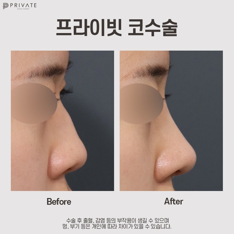 비주코성형수술은 신사 프라이빗성형외과 사진 10