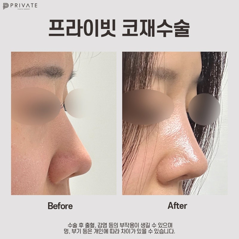코 재수술 병원 후기, 프라이빗에서 확인해 사진 9