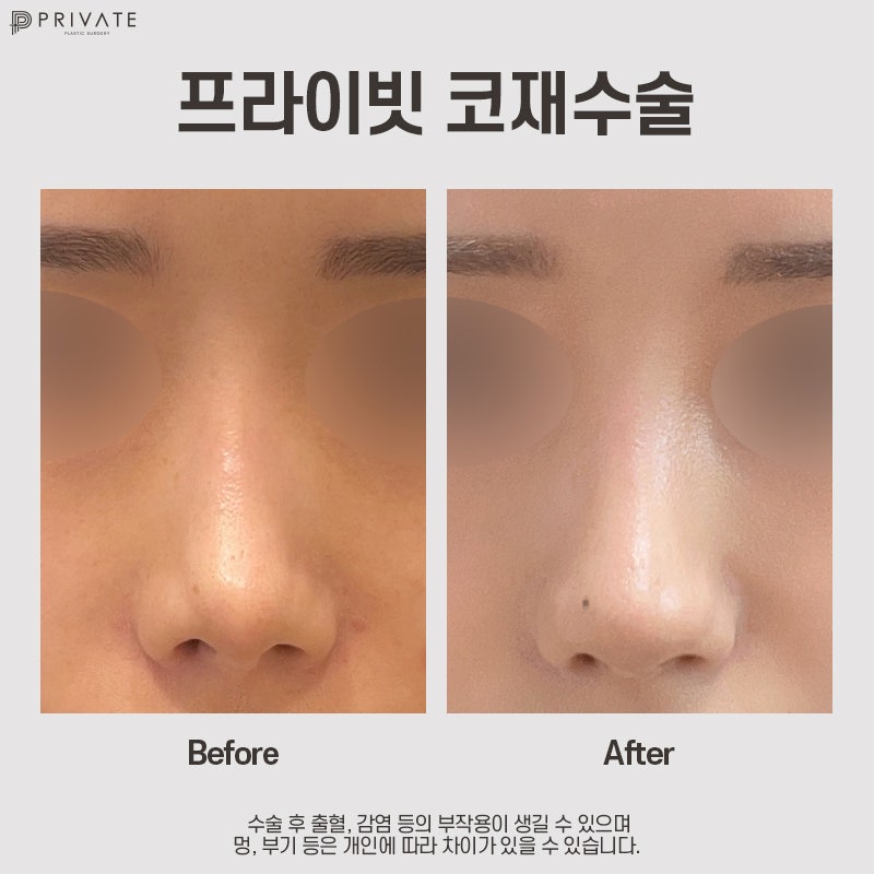 코 재수술 병원 후기, 프라이빗에서 확인해 사진 8