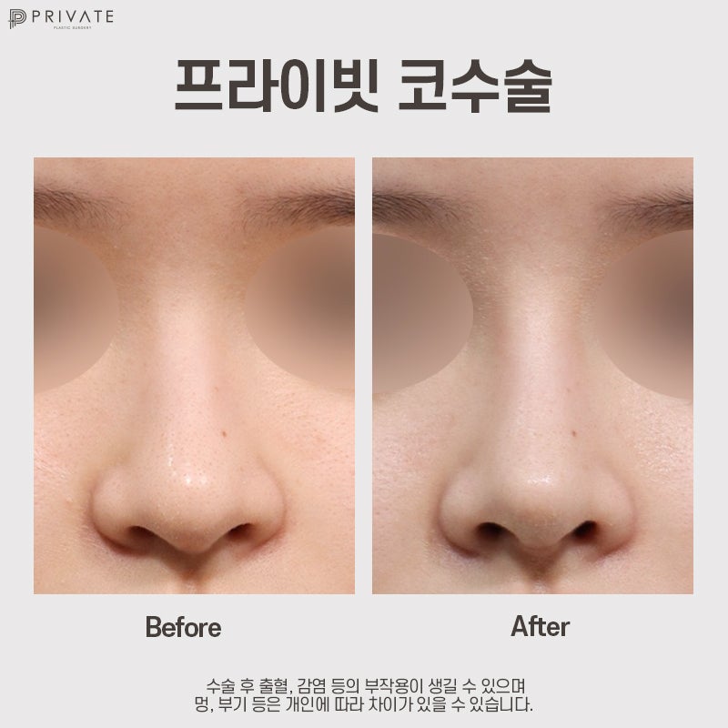 Private Plastic Surgery Clinic Sinsa, dengan ulasan bagus untuk operasi hidung bengkok 사진 8