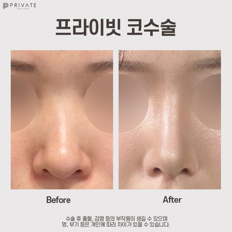 Private Plastic Surgery Clinic Sinsa, dengan ulasan bagus untuk operasi hidung bengkok 사진 7