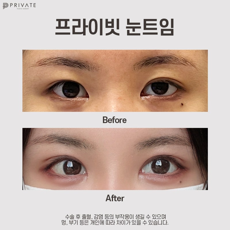 Tempat Terbaik untuk Operasi Mata Terbuka adalah Private Plastic Surgery Clinic 사진 8