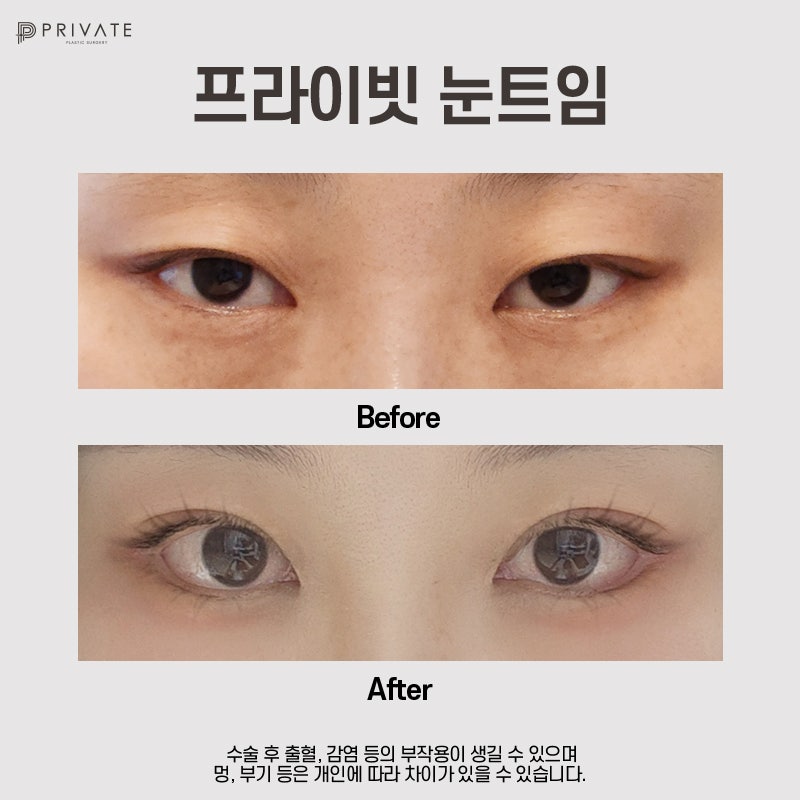 Tempat Terbaik untuk Operasi Mata Terbuka adalah Private Plastic Surgery Clinic 사진 7