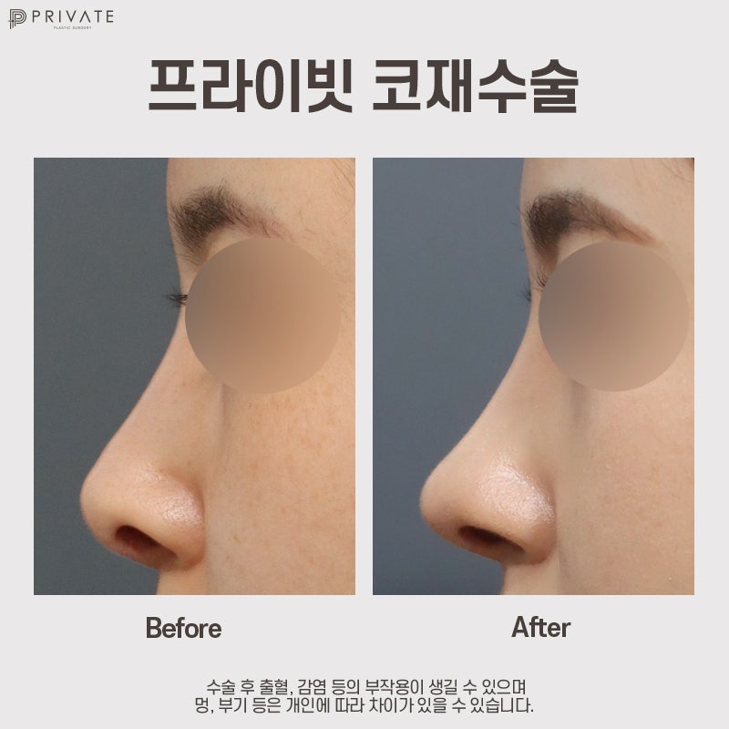 Bedah Revisi Hidung di Klinik Bedah Plastik Privat dengan Ulasan Positif 사진 8