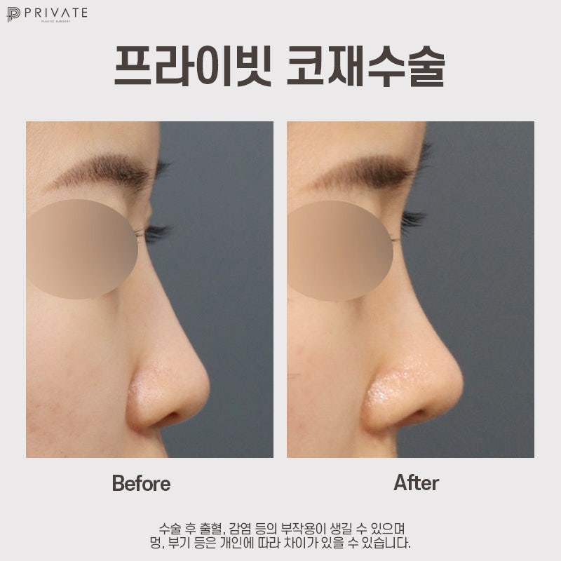 Bedah Revisi Hidung di Klinik Bedah Plastik Privat dengan Ulasan Positif 사진 9