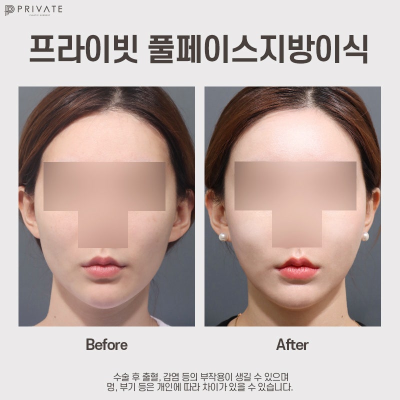 Efek transplantasi lemak PRP, mari kita cari tahu di Private Plastic Surgery 사진 10