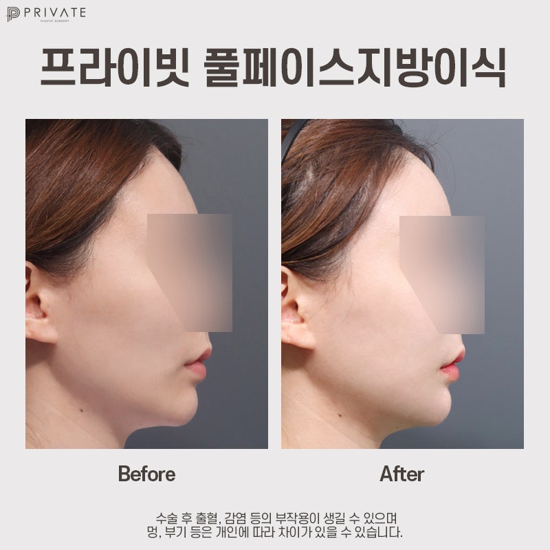 Efek transplantasi lemak PRP, mari kita cari tahu di Private Plastic Surgery 사진 8