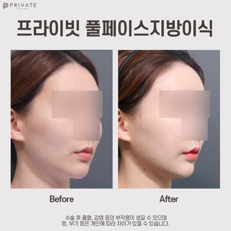 Efek transplantasi lemak PRP, mari kita cari tahu di Private Plastic Surgery 사진 9