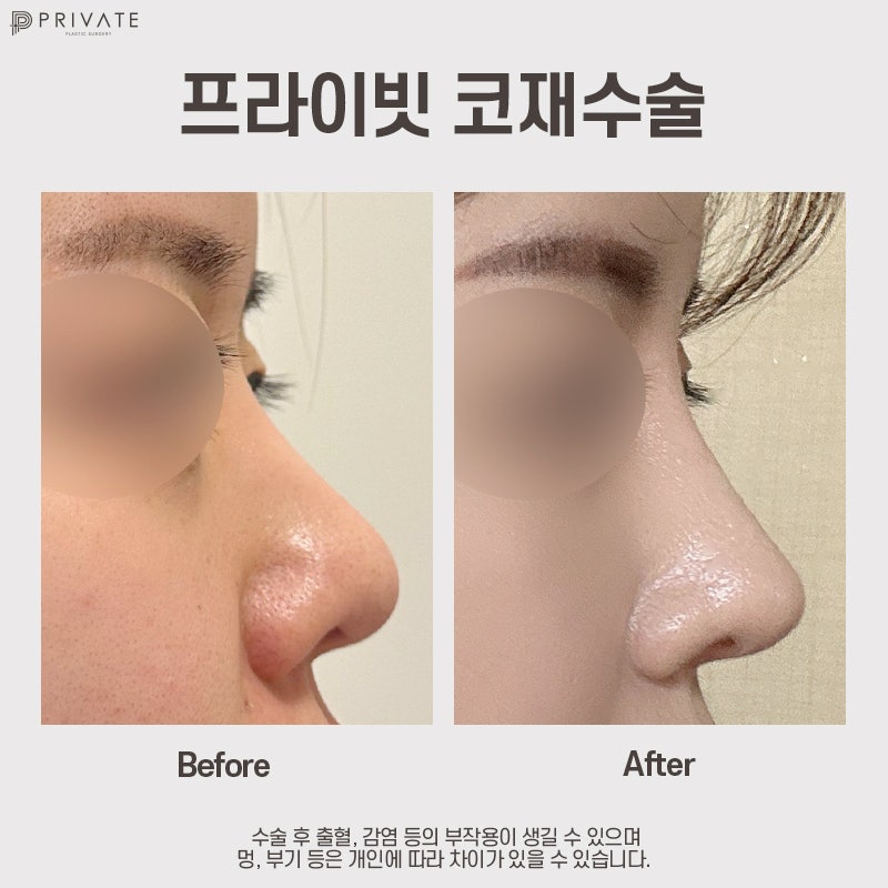 Tempat terbaik untuk operasi hidung revisi adalah Private Plastic Surgery 사진 11